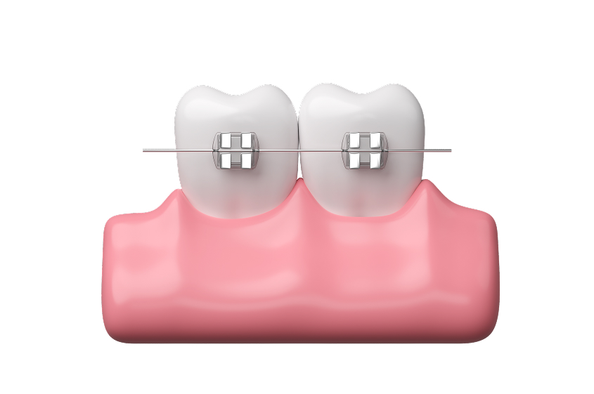 前歯の部分矯正