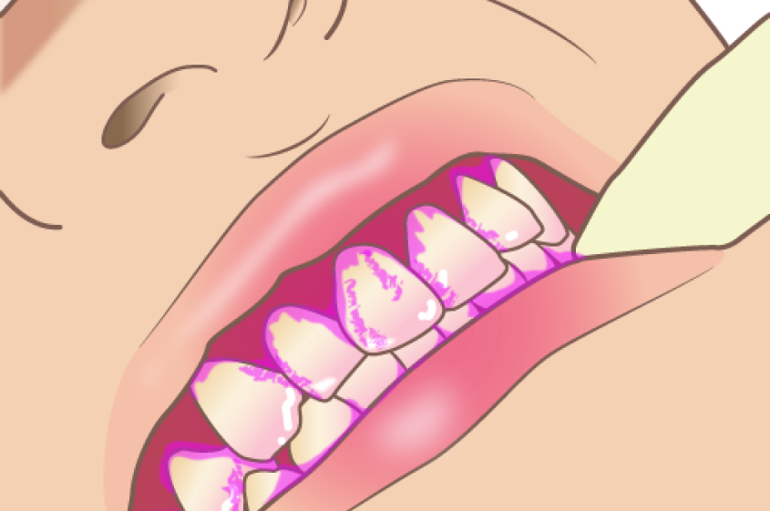 う蝕検知液で虫歯だけを染め出す