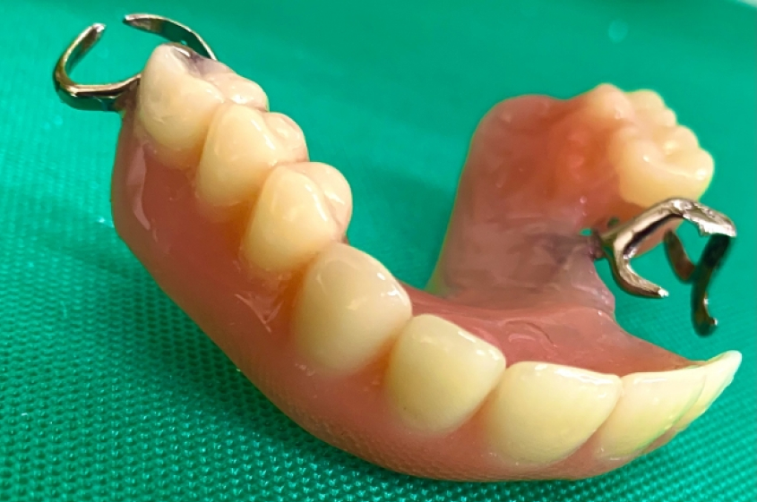 保険レジン床デンチャー