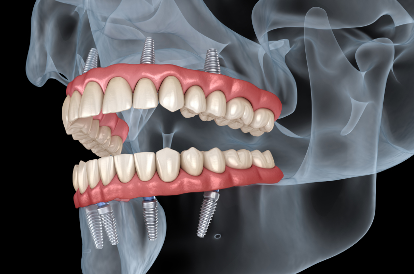 インプラントオーバーデンチャー