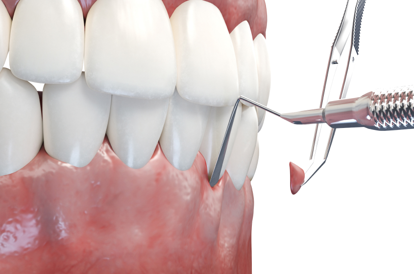 歯周病の進行段階