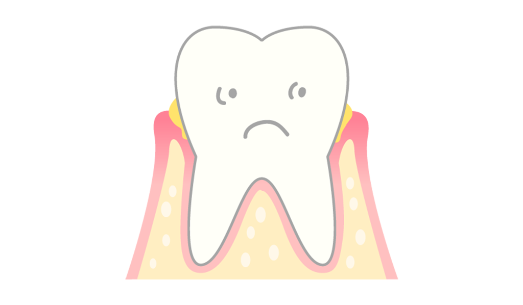 軽度な歯周炎