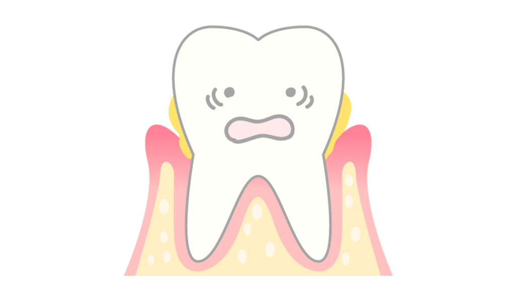 中度の歯周病