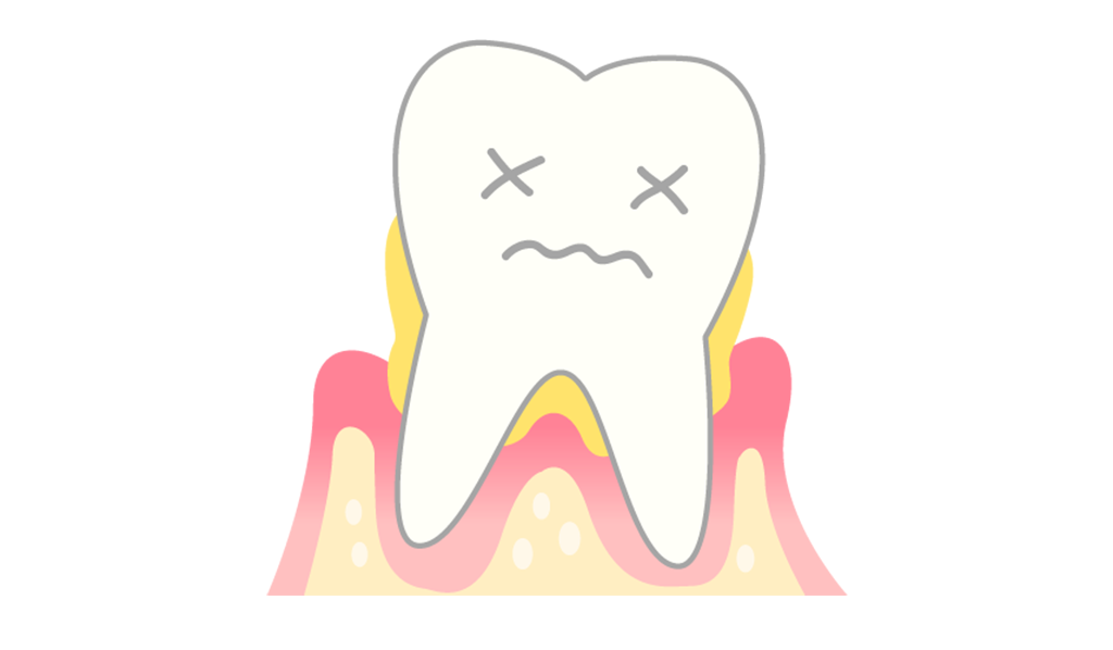 重度の歯周病