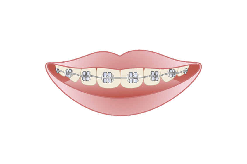 ブラケット矯正