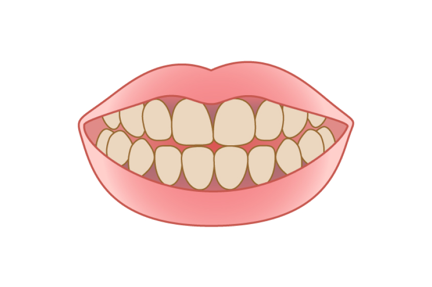 テトラサイクリン歯とは？