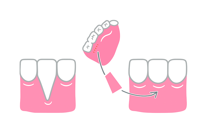 CTG法　（結合組織移植術）